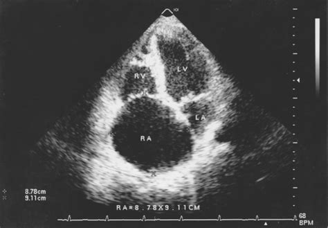A Familial Cluster Of Idiopathic Dilatation Of The Right Atrium A Two
