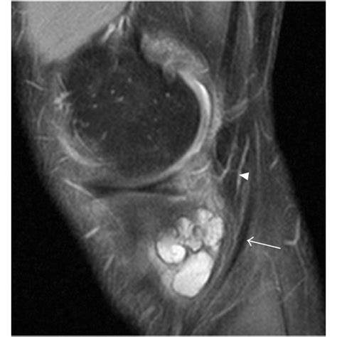 Cluster Of Communicating Extra Capsular Synovial Cysts At The Dorsal