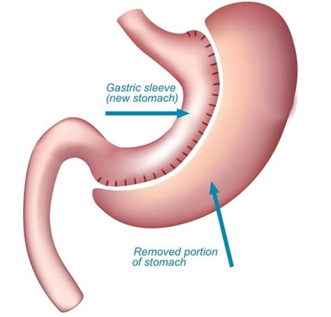 Gastric Sleeve Cyprus Medical Consultancy
