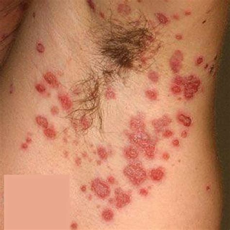 Armpit Rash Itchy Candida Causes And Treatment