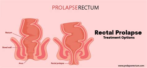 Guide To Evaluate And Test Rectal Prolapse What You Should Know Prolapserectumtreatment