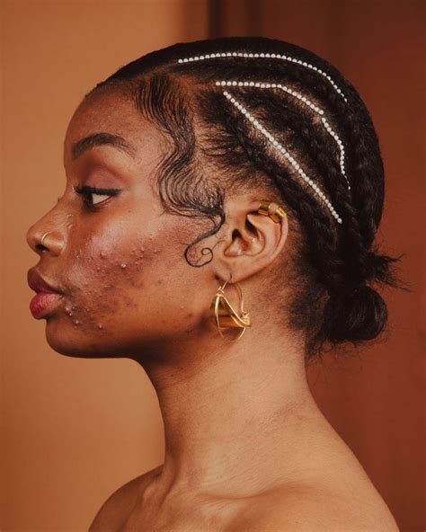 Dermatology Has A Diversity Problem — And It Affects Black Women Skin