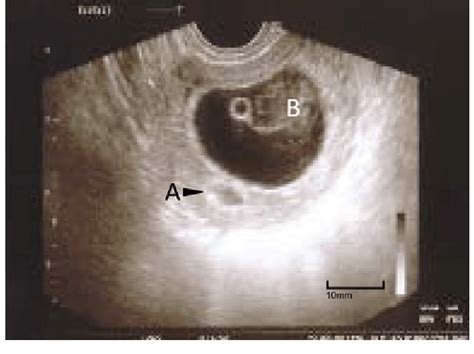 Early Pregnancy With Regression Of Intrauterine Implantation Site A