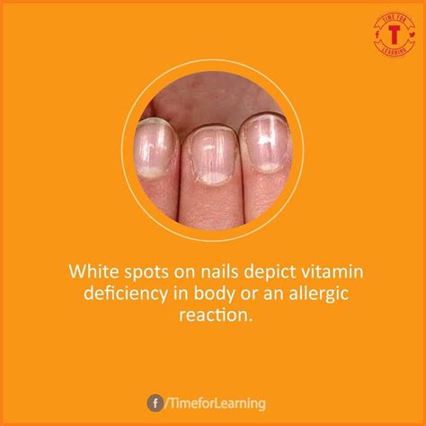Awasome White Spots On Nails Vitamin D Deficiency Ideas Fsabd42