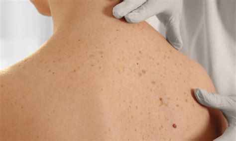 Columbus Age Spot And Freckle Examination Eastside Dermatology