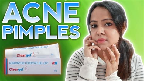 Get Rid Of Acne And Pimples Effective Clear Gel Review Clear Gel