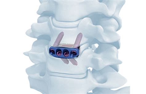 Acdf Anterior Cervical Discectomy Fusion Depuy Synthes