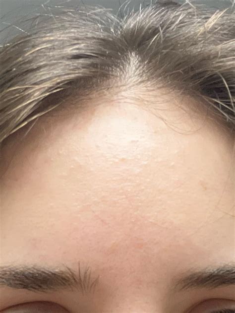 What Are All These Little Bumps On My Forehead Rskincareaddicts