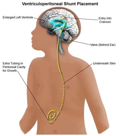 A Diagram Of A VP Shunt Spinal Fluid Brain Drain Vp Shunt