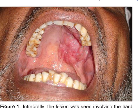 Figure 1 From Adenoid Cystic Carcinoma Of Palate A Case Report And