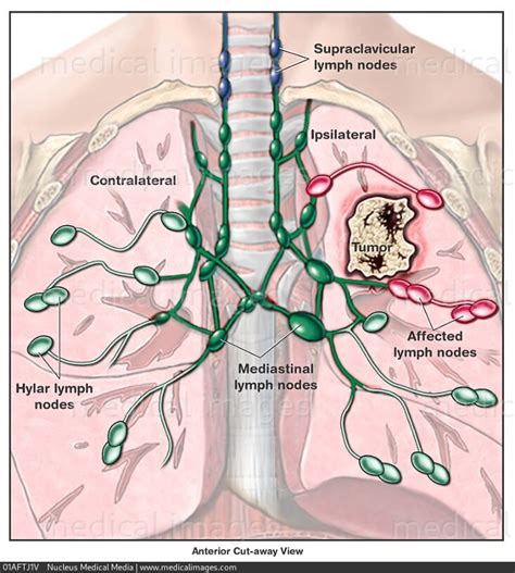 Stock Image Illustration Of Lung Cancer And The Thoracic Lymph Nodes