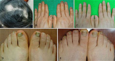 Twenty Nail Dystrophy Treated With Hydroxychloroquine In A Patient With