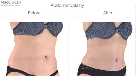 Abdominoplasty Before And After Youtube