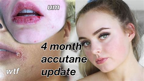 4 Month Accutane Update Horrible Side Effects Conagh Kathleen