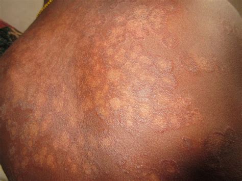 Pityriasis Versicolor What Are The Signs And Symptoms Patient Talk