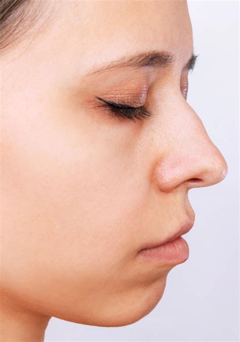 Best Nose Bump Treatment Surrey The Facebible Windsor