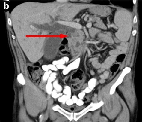 Pre Operative Abdominal Ct A Transverse Ct With Arrow Indicating The