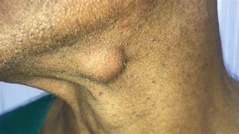 Sebaceous Cyst Excision Video Youtube