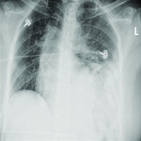 Initial Trauma Bay Chest Radiograph Initial Trauma Bay Chest X Ray