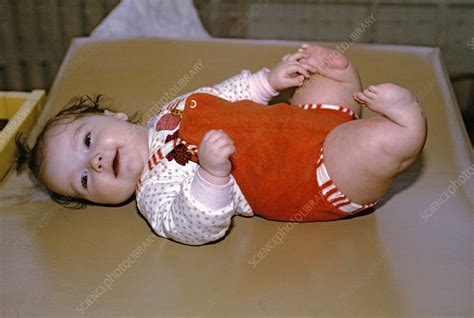 Photos from the 1986 chernobyl disaster. Chernobyl disaster victim, Belarus - Stock Image - C013 ...
