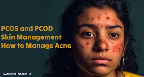 Acne With Pcos How Are They Related And Treatment Hermones