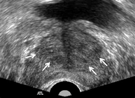 Transrectal Ultrasound Of Benign Prostate Hyperplasia Transrectal My