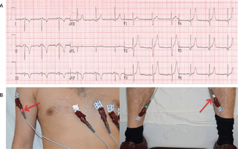 View Of Common Ecg Lead Placement Part I Limb Lead 46 Off