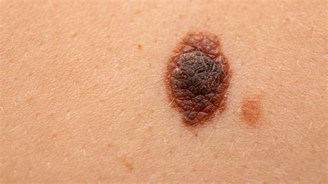 Why Melanoma The Deadliest Skin Cancer Is Rising In