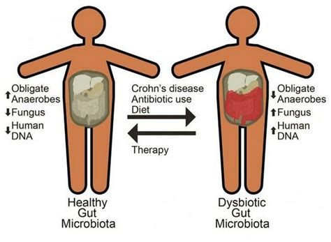 Symptoms Of Crohns Disease And What You Should Do About It Twb