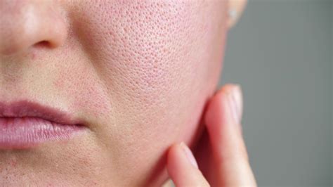 How To Shrink Pores Naturally At Home
