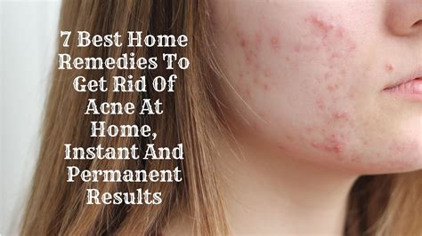 7 Best Home Remedies To Get Rid Of Acne At Home Instant And Permanent