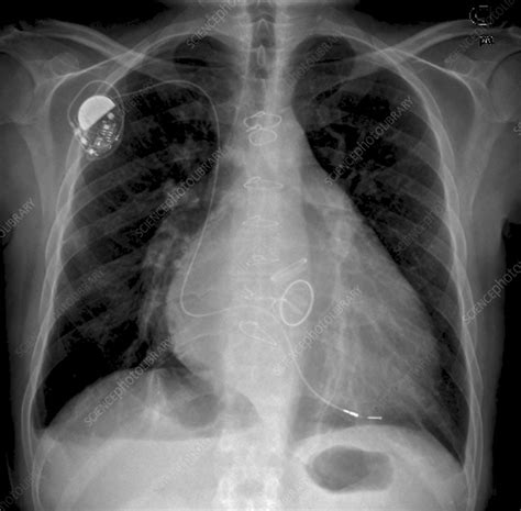 Heart Failure X Ray Stock Image C048 6949 Science Photo Library