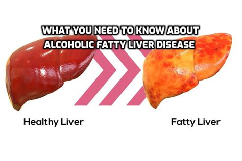 Here Is What You Need To Know About Alcoholic Fatty Liver Disease