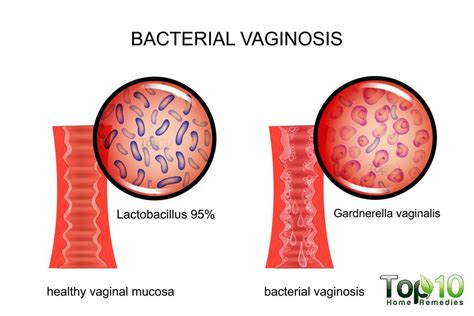 Home Remedies For Bacterial Vaginosis Top 10 Home Remedies