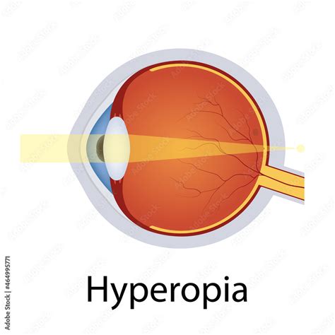 Hyperopia And Vision Disorders Illustration Eyes Defect Concept