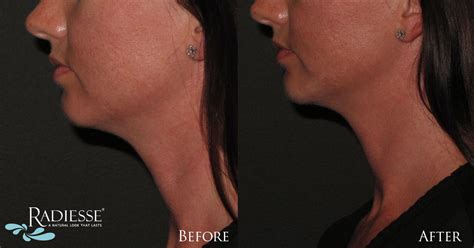 Dermal Fillers Before And After Photos Cosmetic Dermatology Knoxville Tn