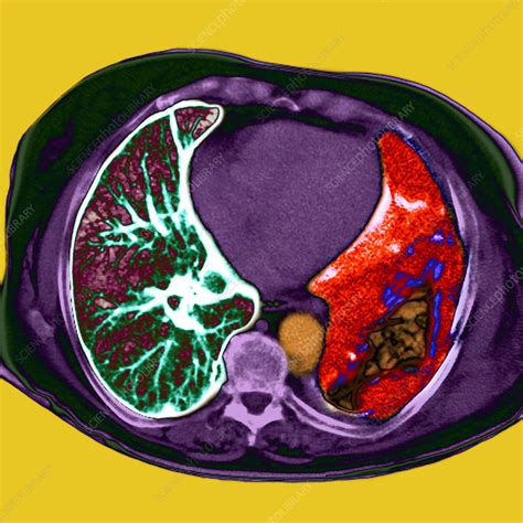 Lung Cancer Ct Scan Stock Image M Science Photo Library