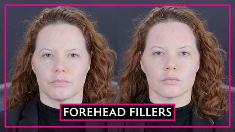 Dermal Fillers For Your Forehead Youtube