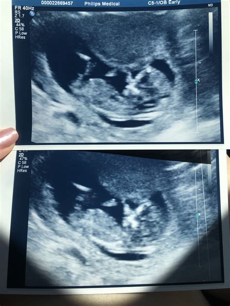 12 Week Ultrasound Gender Predictions