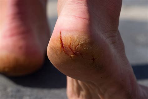 Suffering From Ongoing Cracked Heels How To Avoid Painful Skin Cracks