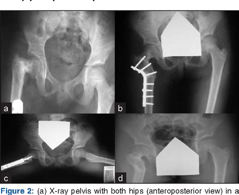 Subtrochanteric Valgus Osteotomy In Developmental Coxa Vara Semantic