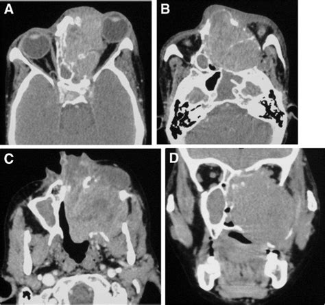 CT Images In Soft Tissue Window Showing Mass In Ethmoid Sinus And Nasal
