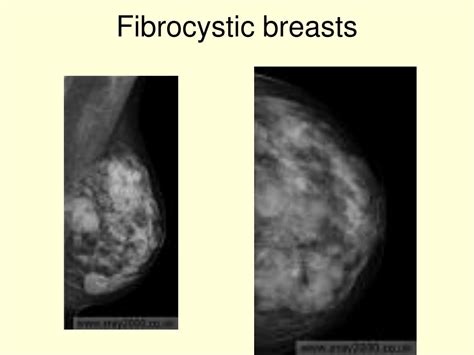 Ppt Mammography 2 Powerpoint Presentation Free Download Id4110986
