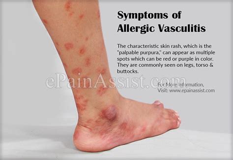 Symptoms Of Hypersensitivity Vasculitis Or Allergic Vasculitis Hypersensitivity Vasculitis
