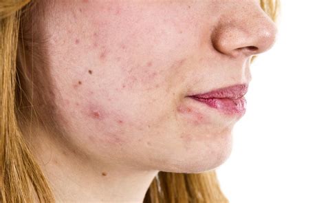 Rashes That Look Like Psoriasis