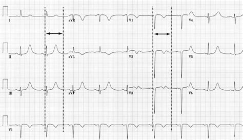 Selamat menikmati video di channel youtube appskep kali ini.pada video ini dibahas materi ukom keperawatan mengenai interpretasi. EKG Part 6 : Repolarisasi Ventrikel (Gelombang T dan U ...