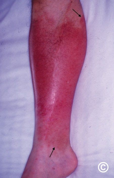 Erysipelas Vs Cellulitis