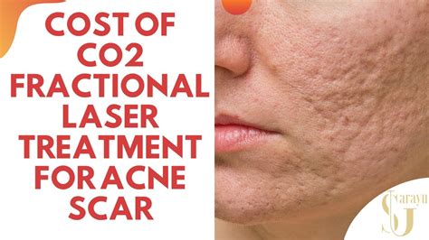 Acne Scar Treatment With Us Fda Approve Fractional Co2 Laser In Delhi