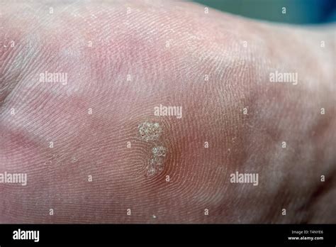 Plantar Wart Hi Res Stock Photography And Images Alamy