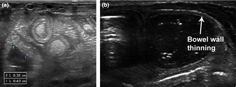 Neonatologist Performed Point‐of‐care Bowel Ultrasound Is The Time